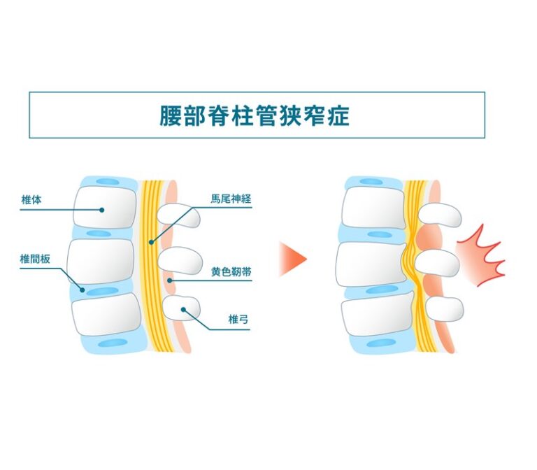 脊柱管狭窄症 / spinal canal stenosisの図