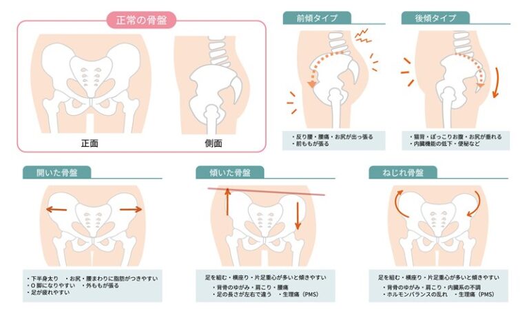 正常な骨盤の位置と歪んだ状態を表した図