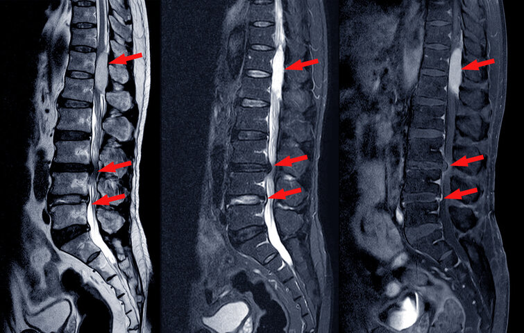 脊柱管狭窄症 / spinal canal stenosis